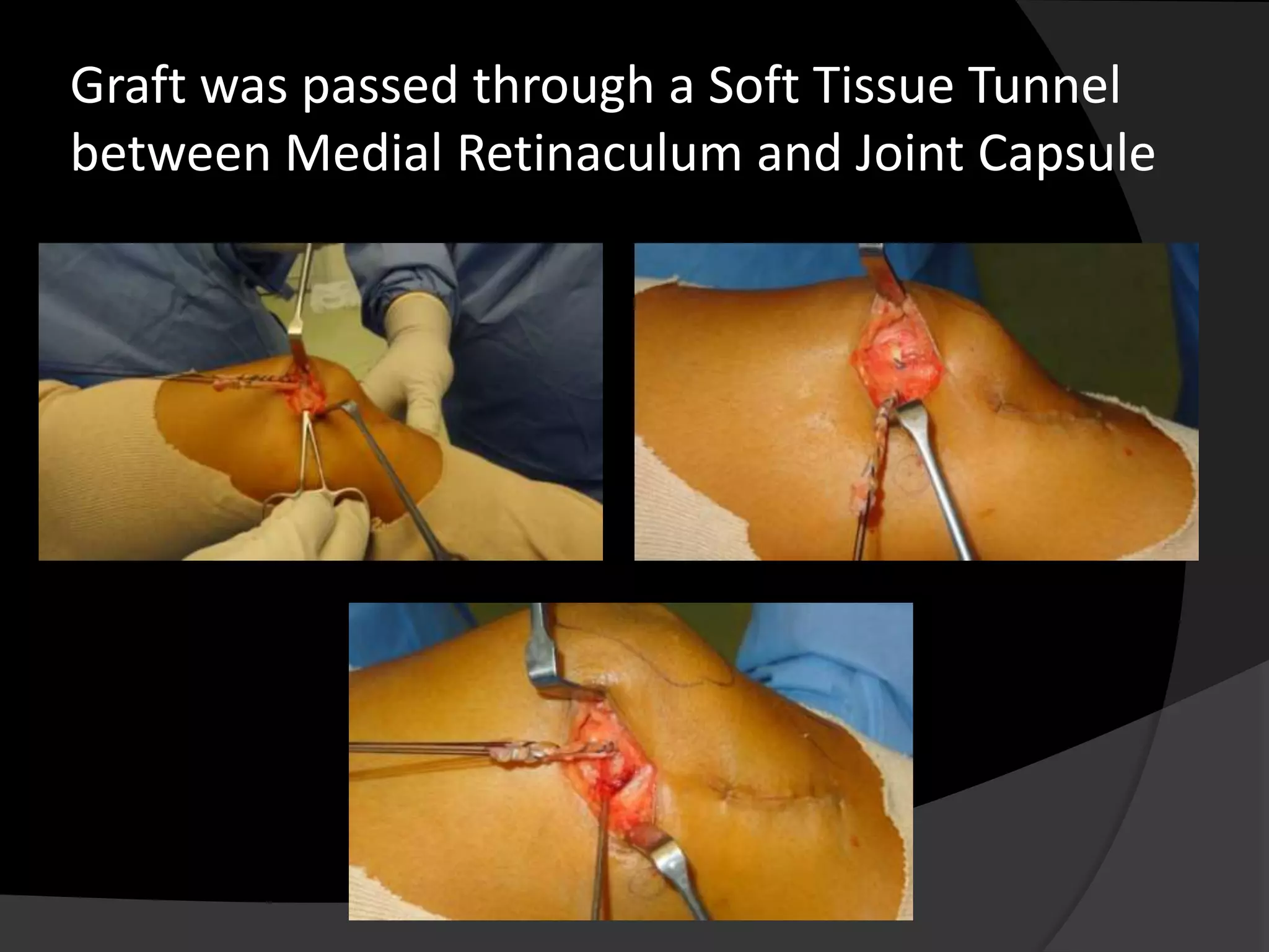 Graft was passed through a Soft Tissue Tunnel
between Medial Retinaculum and Joint Capsule
 