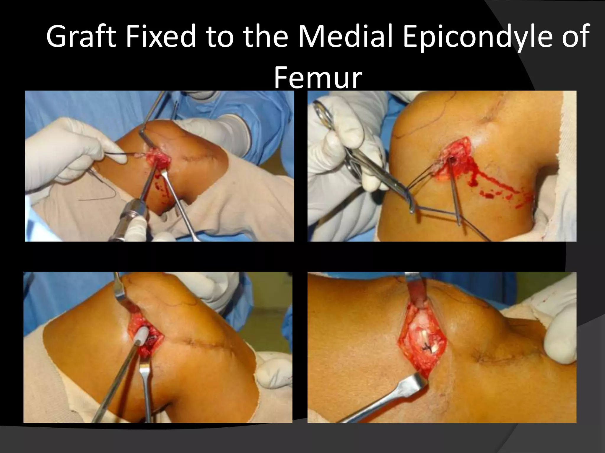 Graft Fixed to the Medial Epicondyle of
                 Femur
 