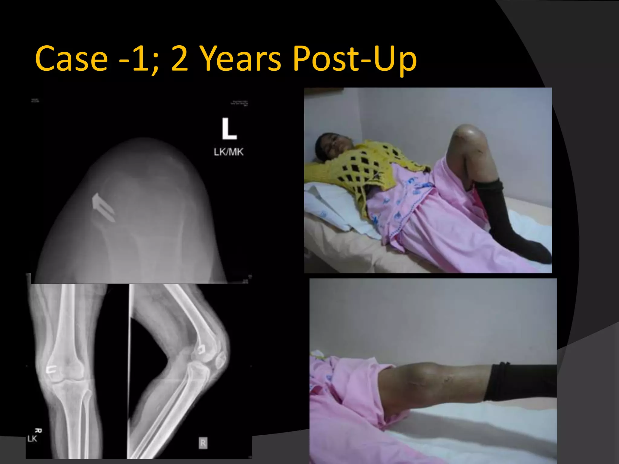 Case -1; 2 Years Post-Up
 