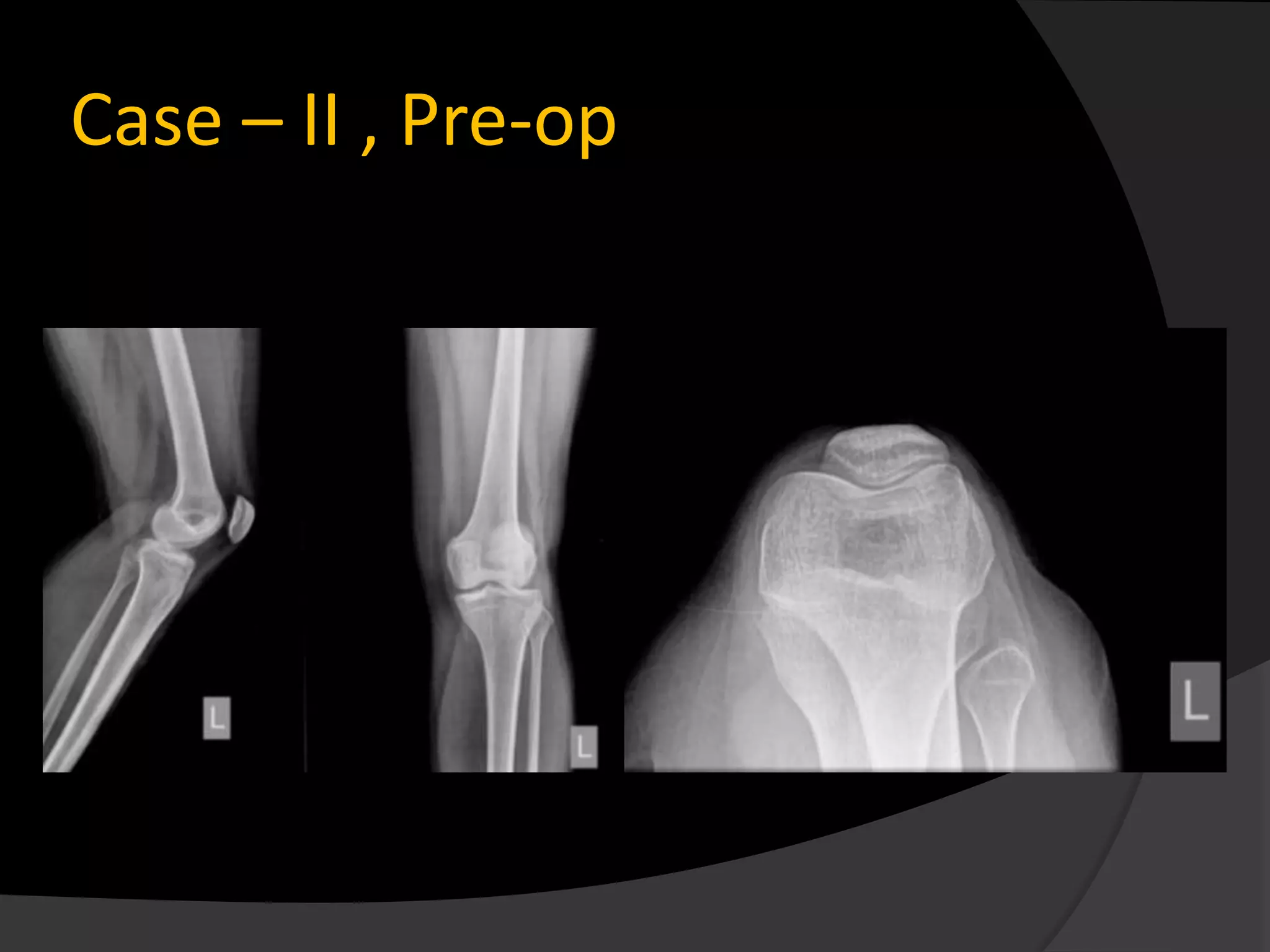 Case – II , Pre-op
 