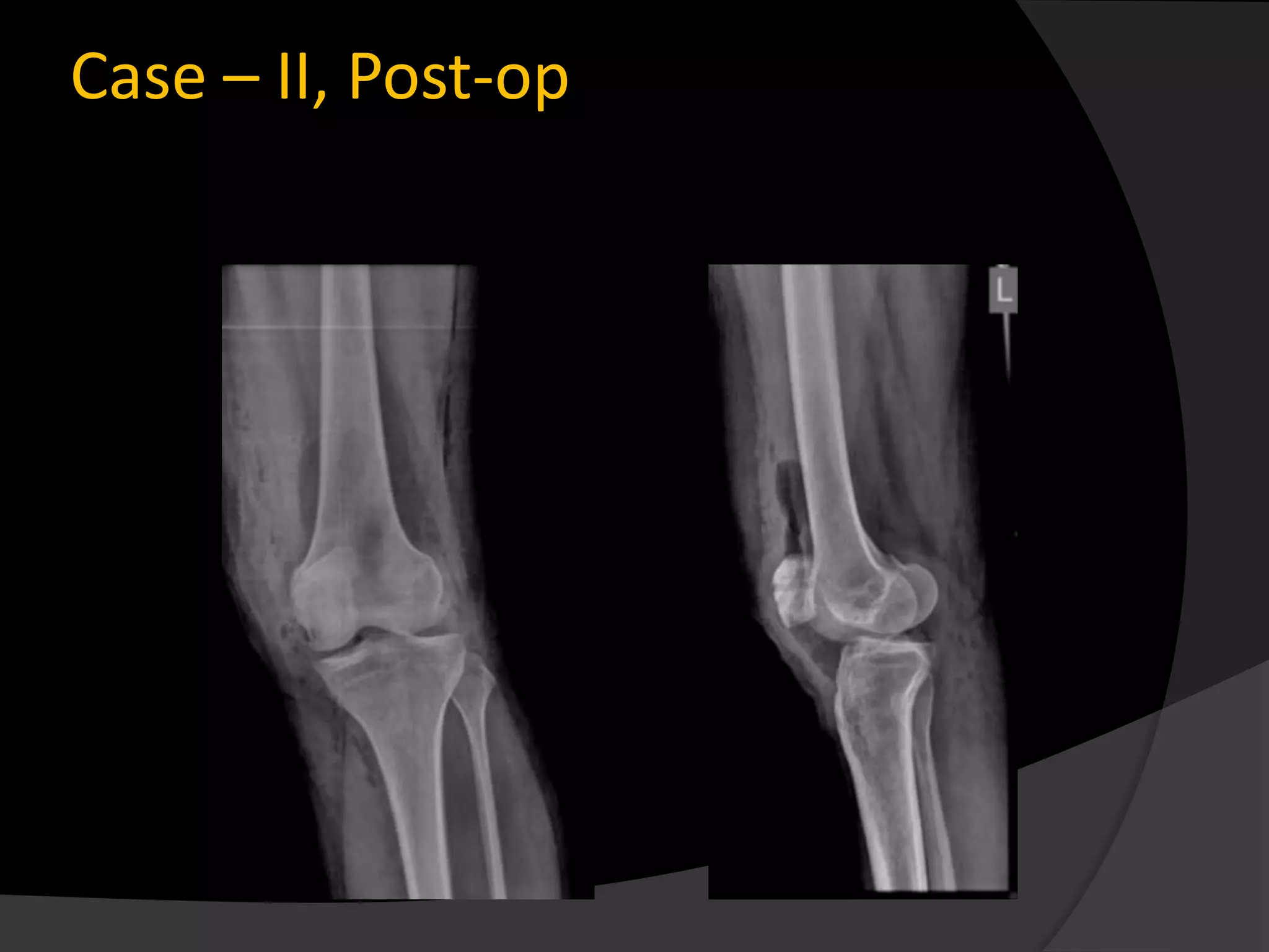 Case – II, Post-op
 