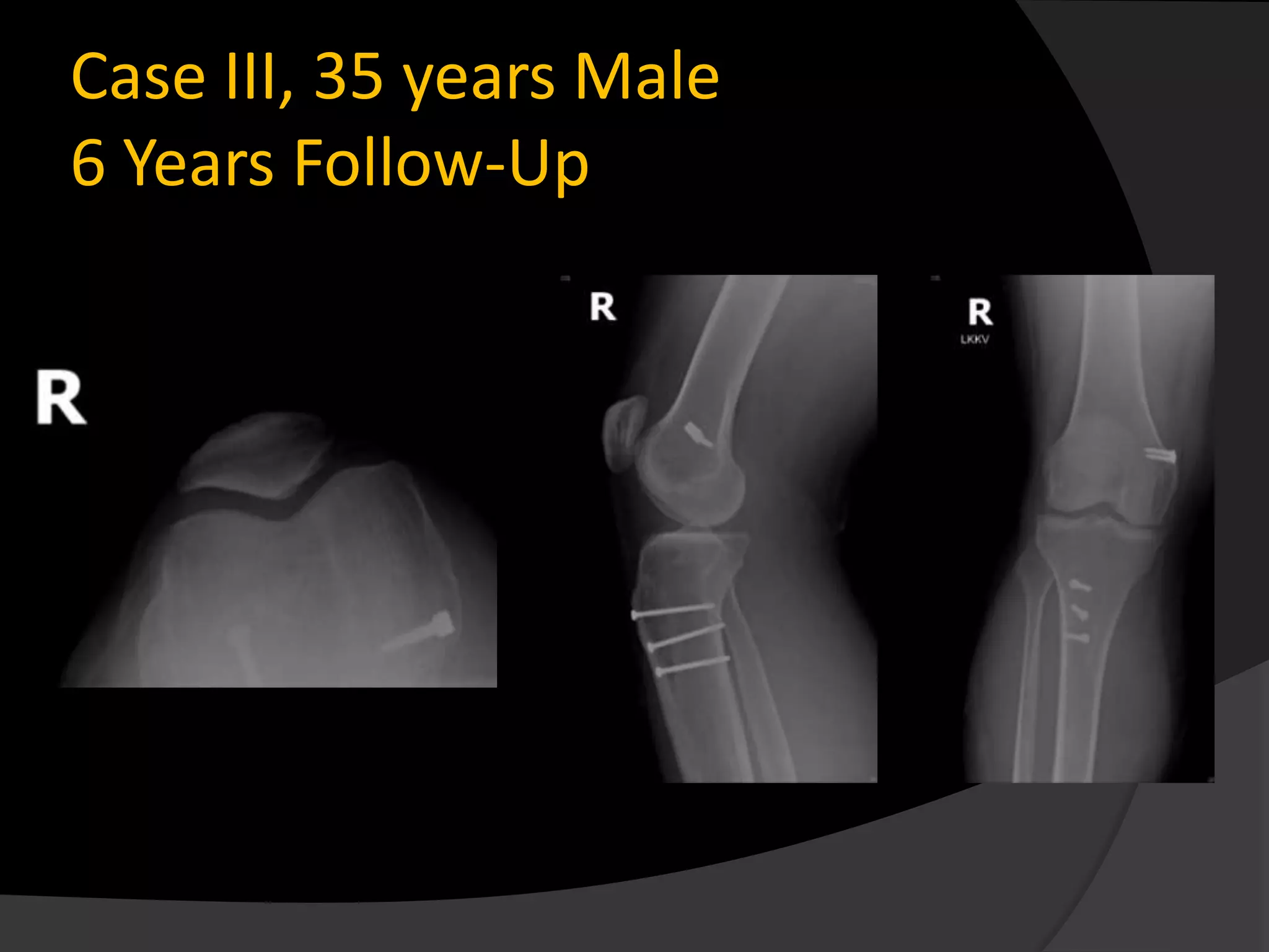 Case III, 35 years Male
6 Years Follow-Up
 