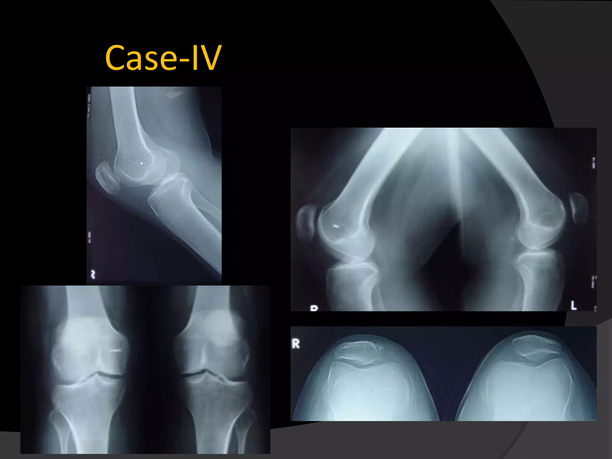 Case-IV
 