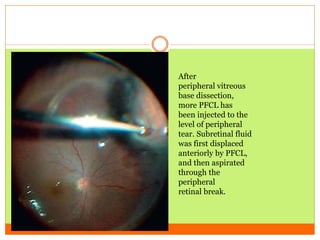 Management of retinal detachment.... | PPTX