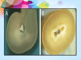Separated Instrument Management of seperated instruments- Dr.Jagadeesh kodityala | PPTX