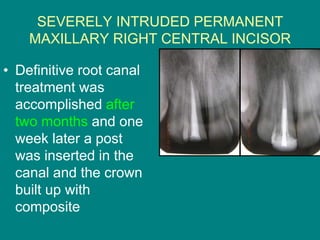 Central Incusors Management of severely intruded central incisor 1 | PPT