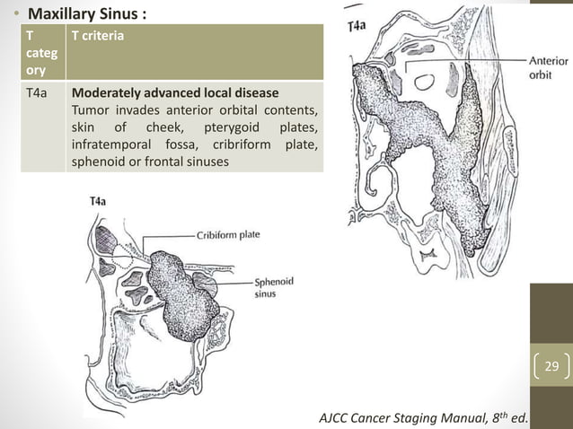 Management of sinonasal tract tumors 27082018 | PPTX | Ear, Nose and ...