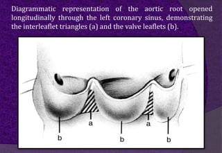 Diagrammatic representation of the aortic root opened
longitudinally through the left coronary sinus, demonstrating
the interleaflet triangles (a) and the valve leaflets (b).
 