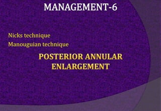 Nicks technique
Manouguian technique
 