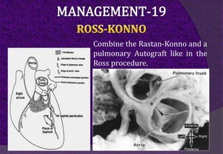 Combine the Rastan-Konno and a
pulmonary Autograft like in the
Ross procedure.
 