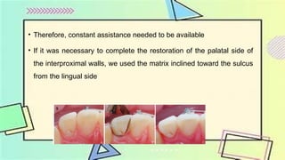 Management of Subgingival Carious Lesion.pptx