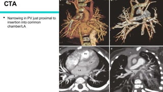 CTA
• Narrowing in PV just proximal to
insertion into common
chamber/LA
 