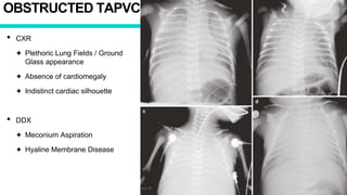 OBSTRUCTED TAPVC
• CXR
✦ Plethoric Lung Fields / Ground
Glass appearance
✦ Absence of cardiomegaly
✦ Indistinct cardiac silhouette
• DDX
✦ Meconium Aspiration
✦ Hyaline Membrane Disease
 