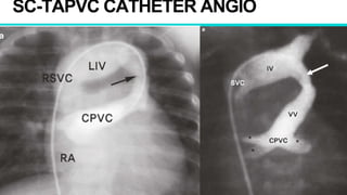 SC-TAPVC CATHETER ANGIO
 