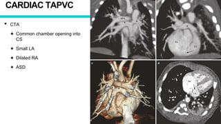 CARDIAC TAPVC
• CTA
✦ Common chamber opening into
CS
✦ Small LA
✦ Dilated RA
✦ ASD
 