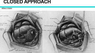 CLOSED APPROACH
William H Muller
 