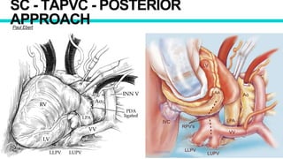 SC - TAPVC - POSTERIOR
APPROACHPaul Ebert
 