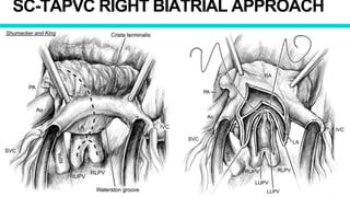 SC-TAPVC RIGHT BIATRIAL APPROACH
Shumacker and King
 