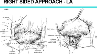 RIGHT SIDED APPROACH - LA
Kirklin
 