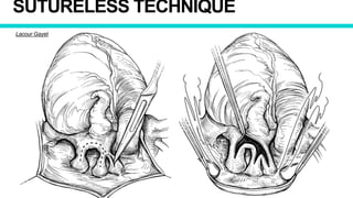 SUTURELESS TECHNIQUE
Lacour Gayet
 