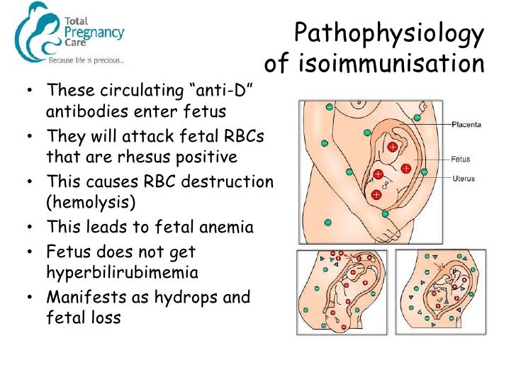 Management Of The Rhesus Negative Mother