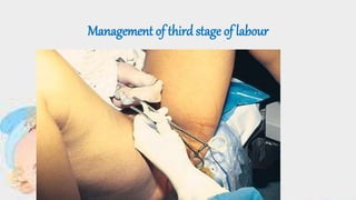 Management of third stage of labour
 