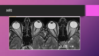 Management of thyroid eye disease | PPTX