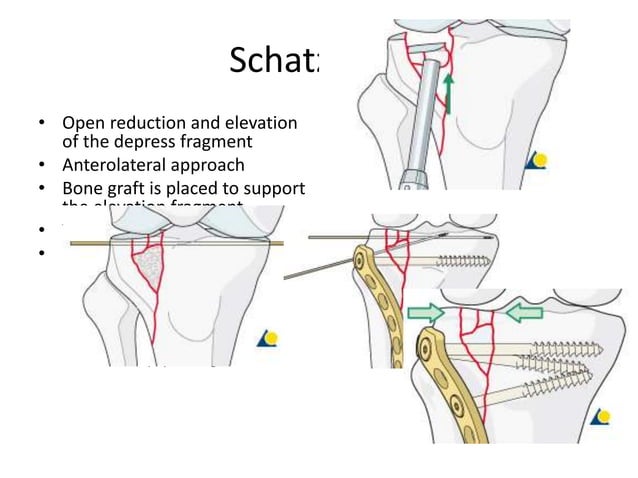 Management of tibial plateau fracture | PPTX