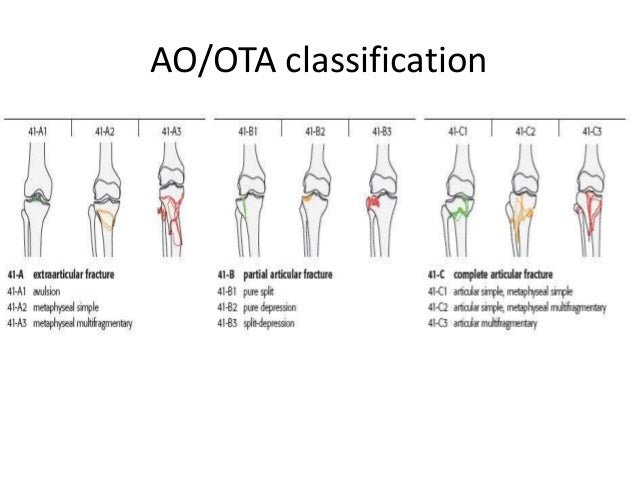 Management Of Tibial Plateau Fracture