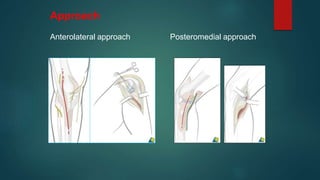 Management of tibial plateau fracture | PPTX