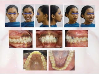 21 years old female came with the complain of irregular teeth
Facial and intraoral evaluation showed:
• Mild convex profil...