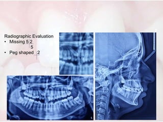 • Treatment progression included:
• Initial upper levelling and alignment was carried out using round
NiTi archwires.
• Sp...