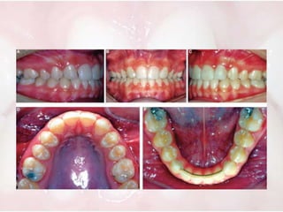 Management of tooth agenesis in orthodontics