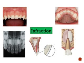 Infraction Tooth managementoftraumaticinjuryofprimarydentition-160509105349.pptx