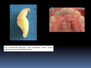 Management of traumatic dental injury of primary teeth | PPTX