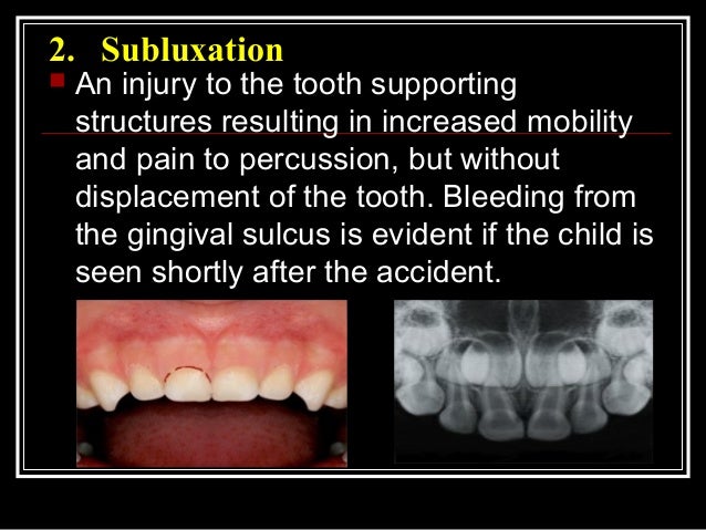 management of traumatic lesions to primary dentition tooth luxation