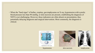 ◦ When the "hard signs" of bullae, crepitus, gas/emphysema on X-ray, hypotension with systolic
blood pressure less than 90 mmHg, or skin necrosis are present, establishing the diagnosis of
NSTI is not challenging. However, these indicators are often absent on presentation, thus
potentially delaying diagnosis and surgical intervention. Most commonly, the diagnosis is
clinical.
skin necrosis
hypotension emphysema
 