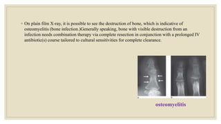 ◦ On plain film X-ray, it is possible to see the destruction of bone, which is indicative of
osteomyelitis (bone infection.)Generally speaking, bone with visible destruction from an
infection needs combination therapy via complete resection in conjunction with a prolonged IV
antibiotic(s) course tailored to cultural sensitivities for complete clearance.
osteomyelitis
 