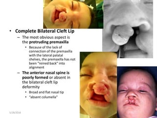 Management of unilateral and bilateral cleft lip, dr. lidetu afework ...