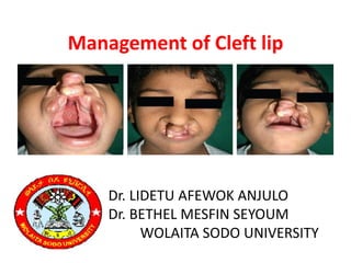 Management of Cleft lip
Dr. LIDETU AFEWOK ANJULO
Dr. BETHEL MESFIN SEYOUM
WOLAITA SODO UNIVERSITY
 