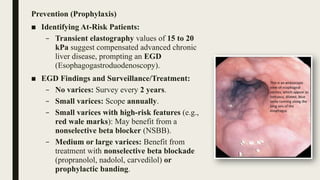 Egd Risks Management of upper gastrointestinal tract bleeding nausheen-1.pptx