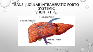 TRANS-JUGULAR INTRAHEPATIC PORTO-
SYSTEMIC
SHUNT (TIPS)
 