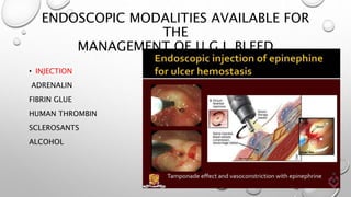 ENDOSCOPIC MODALITIES AVAILABLE FOR
THE
MANAGEMENT OF U.G.I. BLEED
• INJECTION
ADRENALIN
FIBRIN GLUE
HUMAN THROMBIN
SCLEROSANTS
ALCOHOL
 