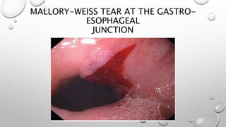 MALLORY-WEISS TEAR AT THE GASTRO-
ESOPHAGEAL
JUNCTION
 