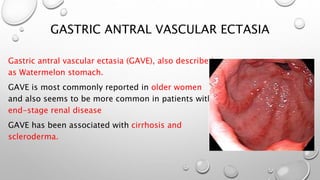 GASTRIC ANTRAL VASCULAR ECTASIA
Gastric antral vascular ectasia (GAVE), also described
as Watermelon stomach.
GAVE is most commonly reported in older women
and also seems to be more common in patients with
end-stage renal disease
GAVE has been associated with cirrhosis and
scleroderma.
 