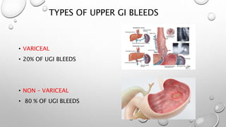 TYPES OF UPPER GI BLEEDS
• VARICEAL
• 20% OF UGI BLEEDS
• NON – VARICEAL
• 80 % OF UGI BLEEDS
 