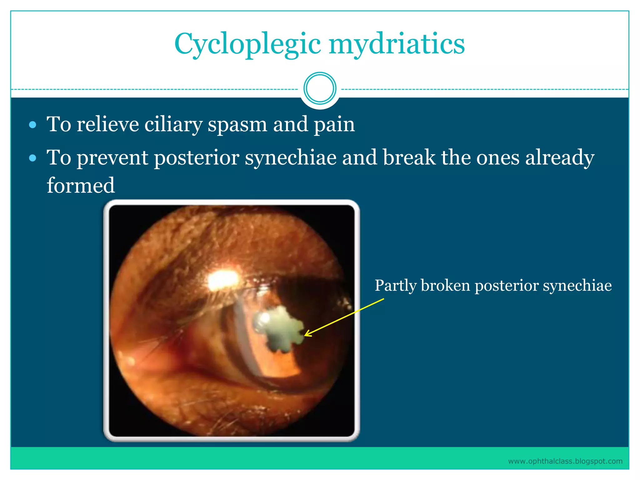 Management of uveitis