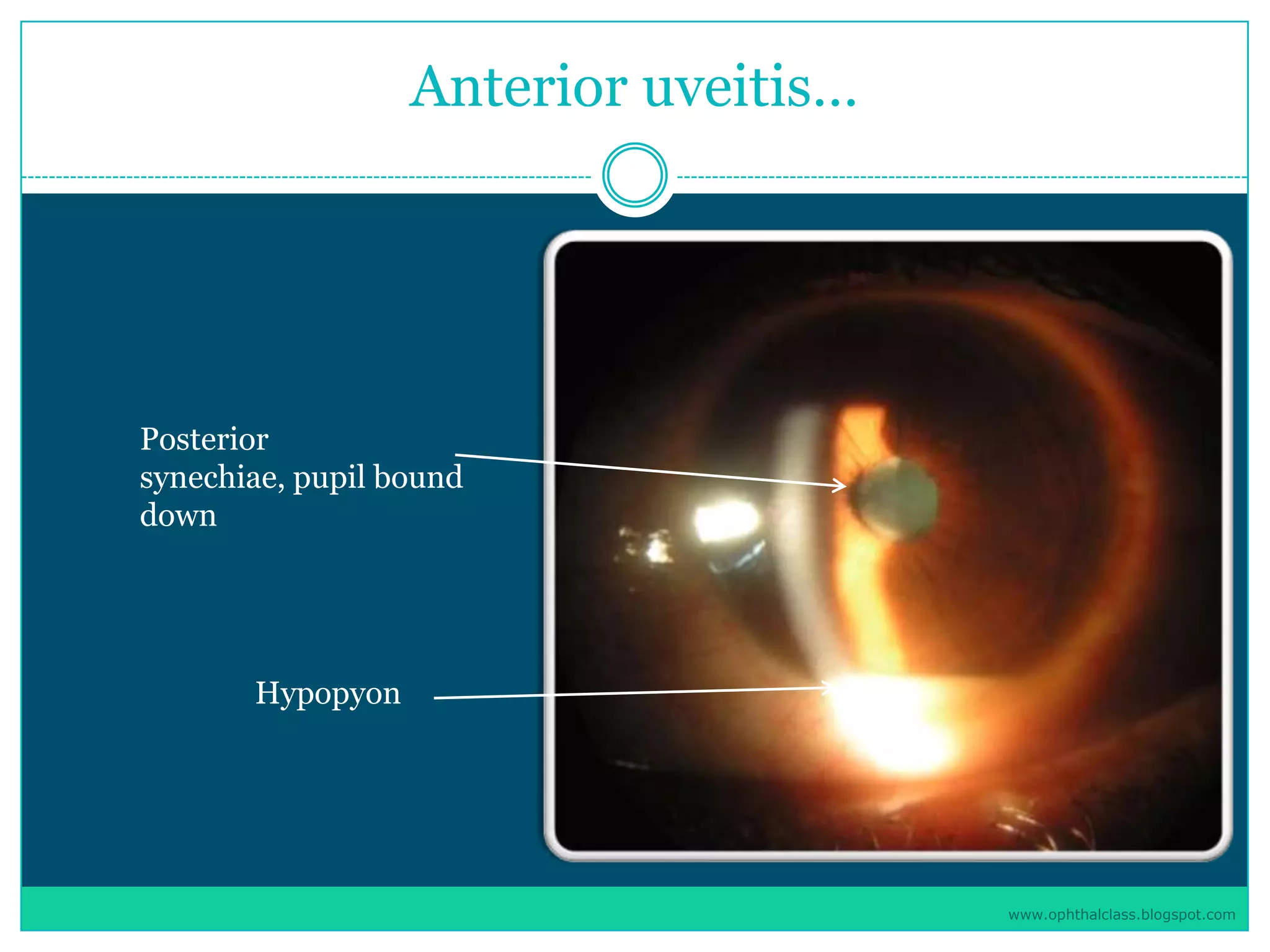 Management of uveitis