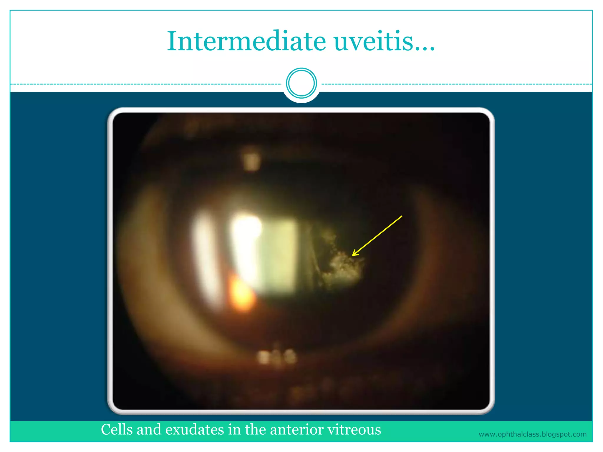 Management of uveitis