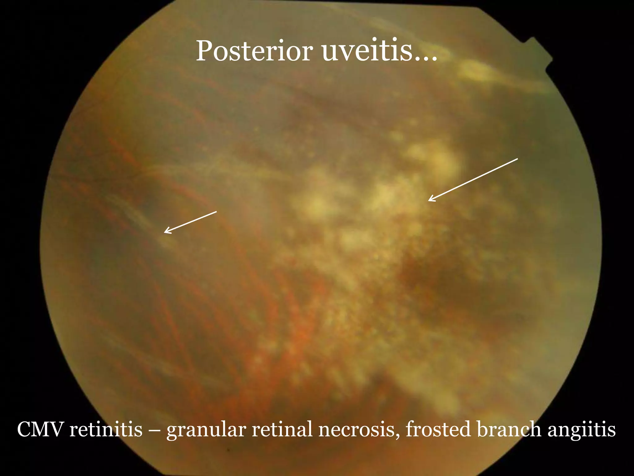 Management of uveitis